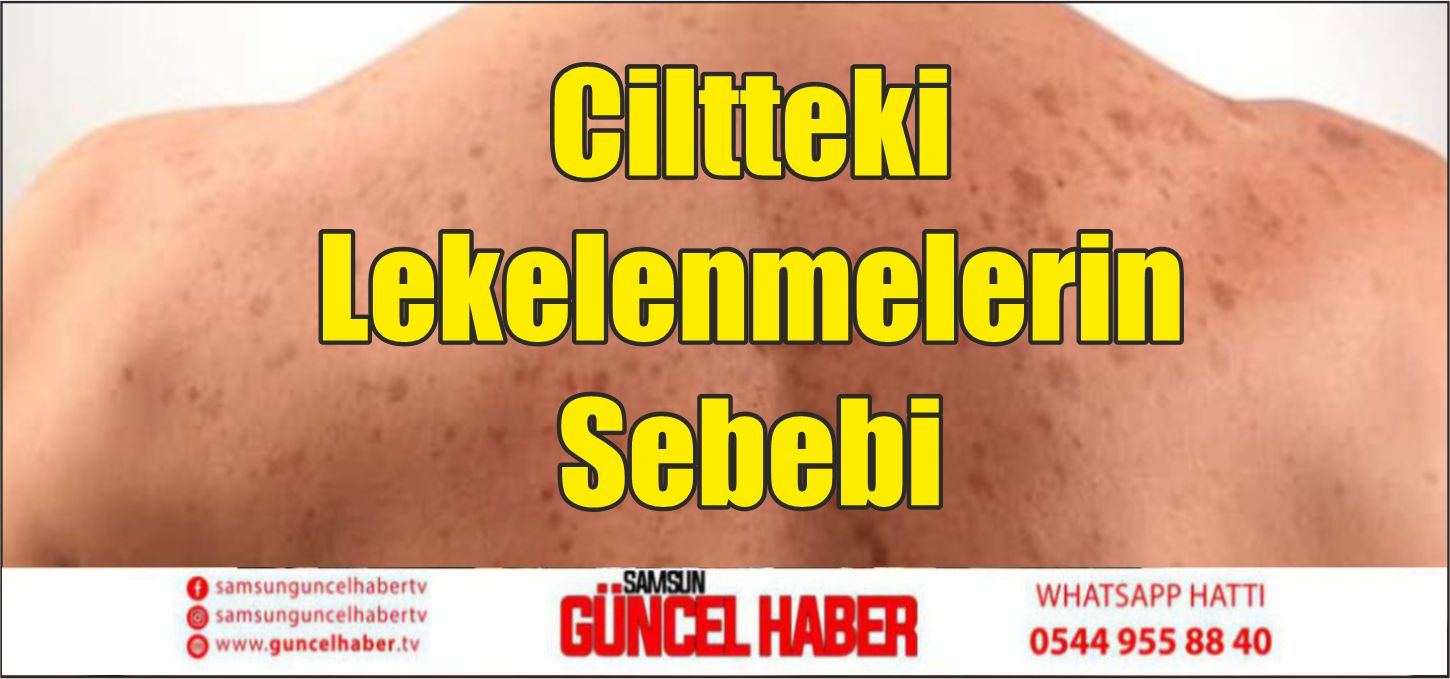 Ciltteki Lekelenmelerin Sebebi